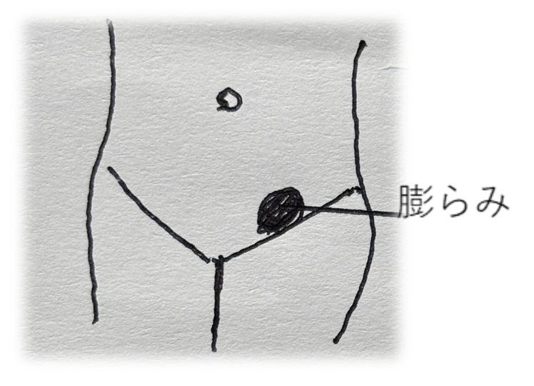 膨らみ